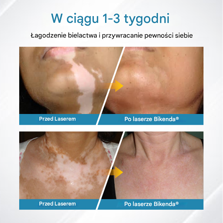 ✅Urządzenie do terapii bielactwa Bikenda® DermaBeam