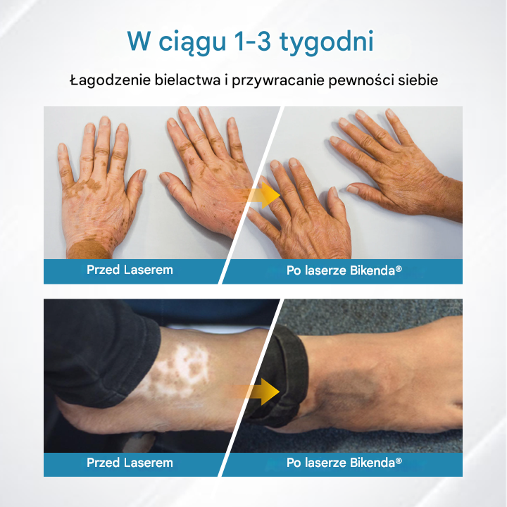 ✅Urządzenie do terapii bielactwa Bikenda® DermaBeam
