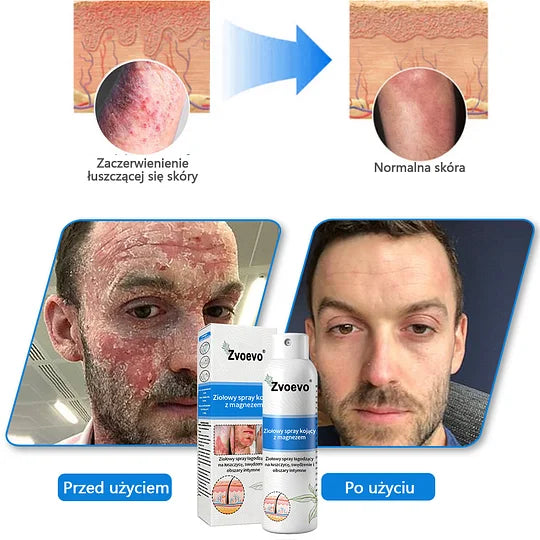 Oficjalny sklep✅: Zvoevo®Magnezowy spray ziołowy na łuszczycę⚕️Certyfikowany przez URPL (ulga w łuszczycy i egzemie, poprawa stanu bakteryjnych infekcji narządów płciowych oraz leczenie trądziku i przebarwień)✨✨✨✨