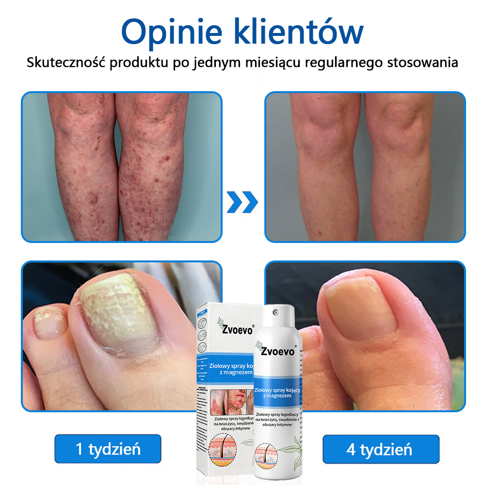 Oficjalny sklep✅: Zvoevo®Magnezowy spray ziołowy na łuszczycę⚕️Certyfikowany przez URPL (ulga w łuszczycy i egzemie, poprawa stanu bakteryjnych infekcji narządów płciowych oraz leczenie trądziku i przebarwień)✨✨✨✨