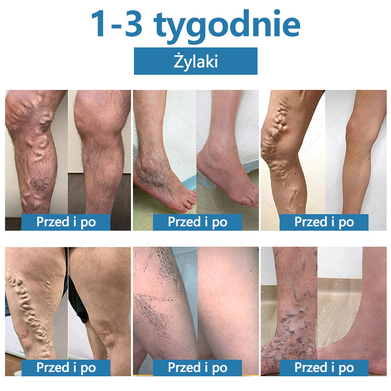SIENOVA™💎 Przenośne urządzenie limfatyczne i rozluźniające stawy Urządzenie👨⚕️ Oryginalna terapia 2 w 1 | Certyfikat URPL