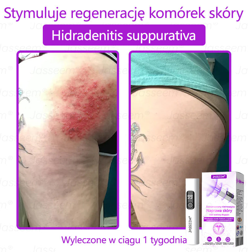 🔥🔥🔥𝐉𝐚𝐬𝐬𝐞𝐞𝐦® Zaawansowany nieinwazyjny laser CO₂ do naprawy skóry 🎉 (Delikatnie usuwa brodawki, znamiona, plamy starcze i narośla skórne – bez bólu, bez zamieszania!)