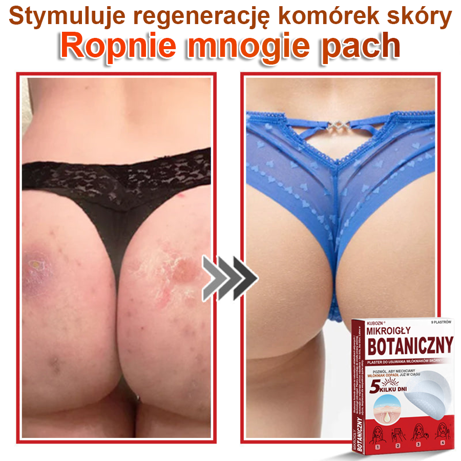 KUBOZN® Mikroigłowy botaniczny środek do usuwania narośli skórnych ✅✅✅✅wyprodukowano w Polsce