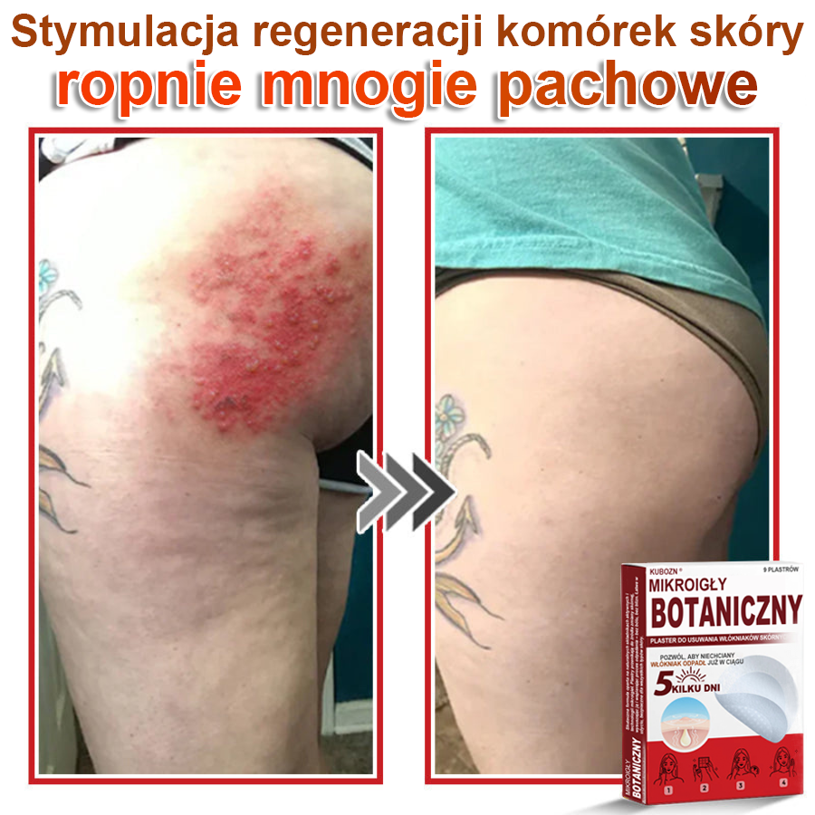 KUBOZN® Mikroigłowy botaniczny środek do usuwania narośli skórnych ✅✅✅✅wyprodukowano w Polsce