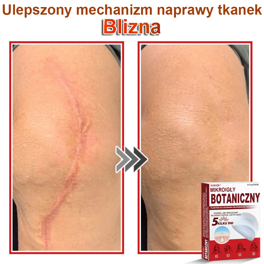 KUBOZN® Mikroigłowy botaniczny środek do usuwania narośli skórnych ✅✅✅✅wyprodukowano w Polsce