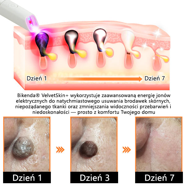 ✨✨✨ Bikenda® VelvetSkin+ – Laserowy Długopis CO₂ do Usuwania 🟤 Znamion, 🦠 Brodawek, 🔘 Przebarwień i Innych Niedoskonałości Skóry 🌿