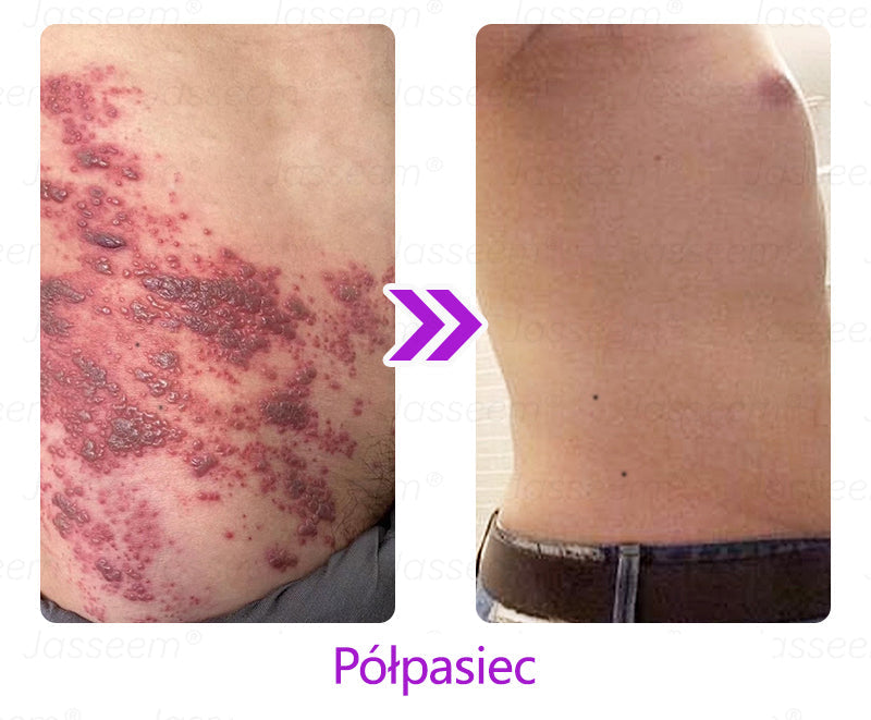 🔥🔥🔥𝐉𝐚𝐬𝐬𝐞𝐞𝐦® Zaawansowany nieinwazyjny laser CO₂ do naprawy skóry 🎉 (Delikatnie usuwa brodawki, znamiona, plamy starcze i narośla skórne – bez bólu, bez zamieszania!)
