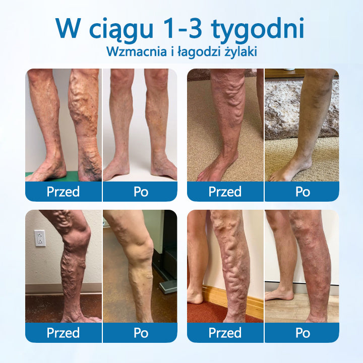 Timilk® VeinGuard Herbal Spray-✅✅✅ Klinicznie udowodniono, że eliminuje żylaki w zaledwie 7 dni!