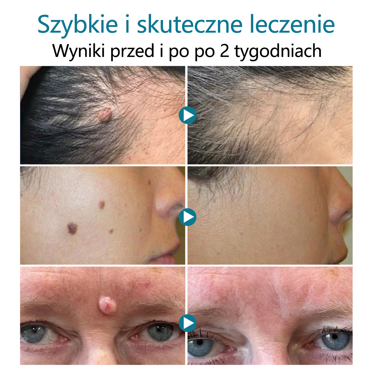 ✅Pióro laserowe do usuwania moli i brodawek Bikenda® LumeSkin