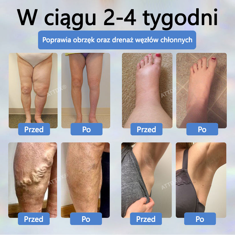 💧💧💧ATTDX® Krem ziołowy łagodzący obrzęki z czarnuszką