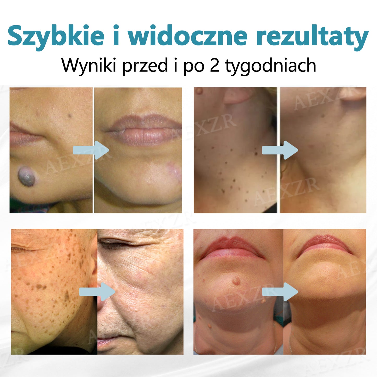 Bikenda® NOWOŚĆ Nieinwazyjny laser do usuwania pieprzyków i brodawek🔥🔥🔥