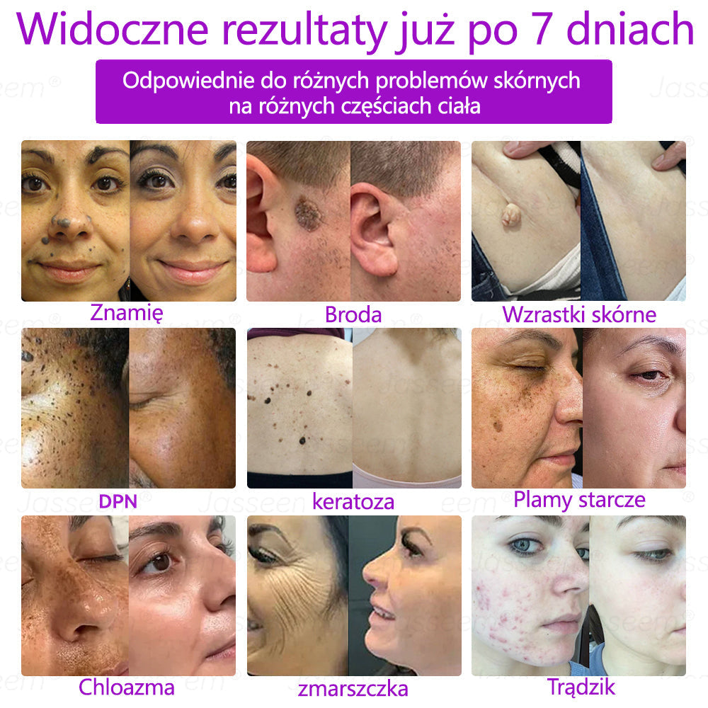 🔥🔥🔥𝐉𝐚𝐬𝐬𝐞𝐞𝐦® Zaawansowany nieinwazyjny laser CO₂ do naprawy skóry 🎉 (Delikatnie usuwa brodawki, znamiona, plamy starcze i narośla skórne – bez bólu, bez zamieszania!)
