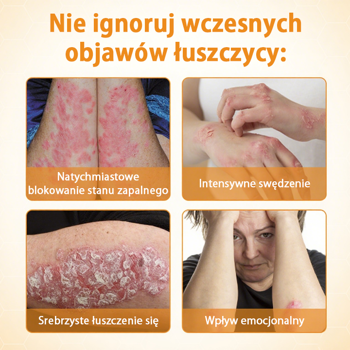 Timilk® BeeLieve Łuszczyca Pielęgnacja skóry🌿🌿🌿