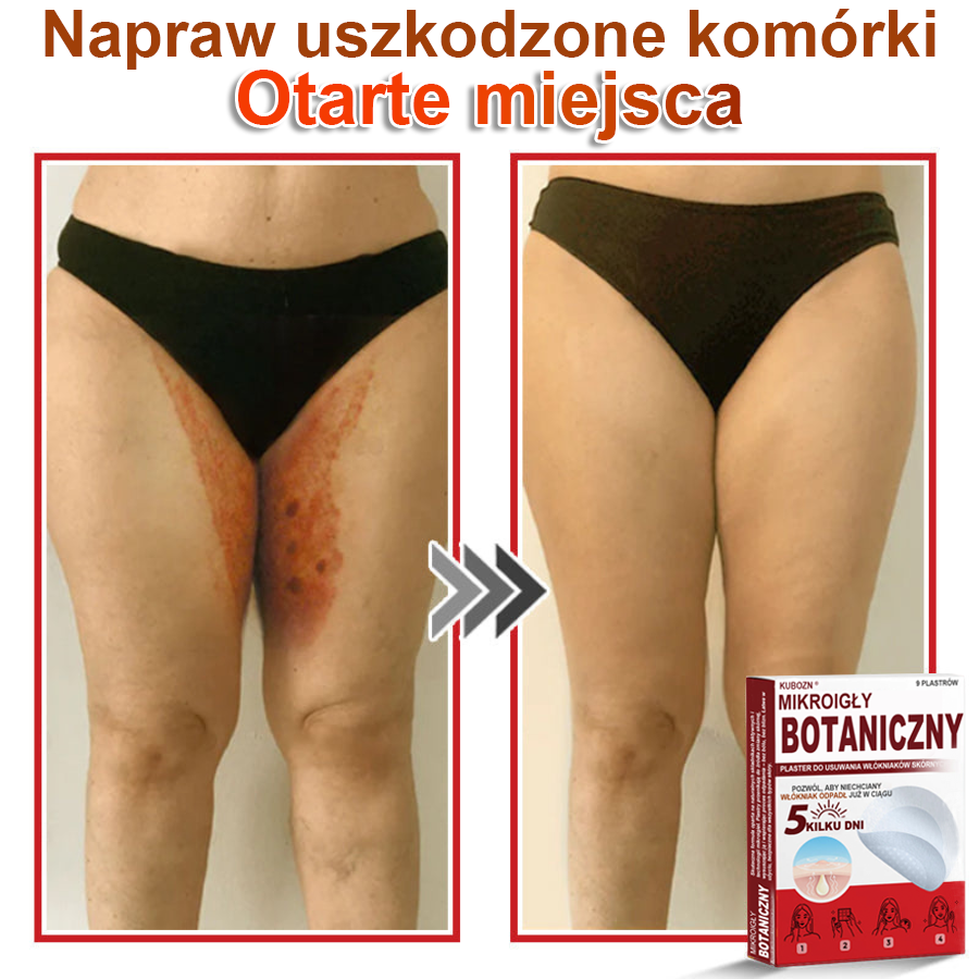KUBOZN® Mikroigłowy botaniczny środek do usuwania narośli skórnych ✅✅✅✅wyprodukowano w Polsce