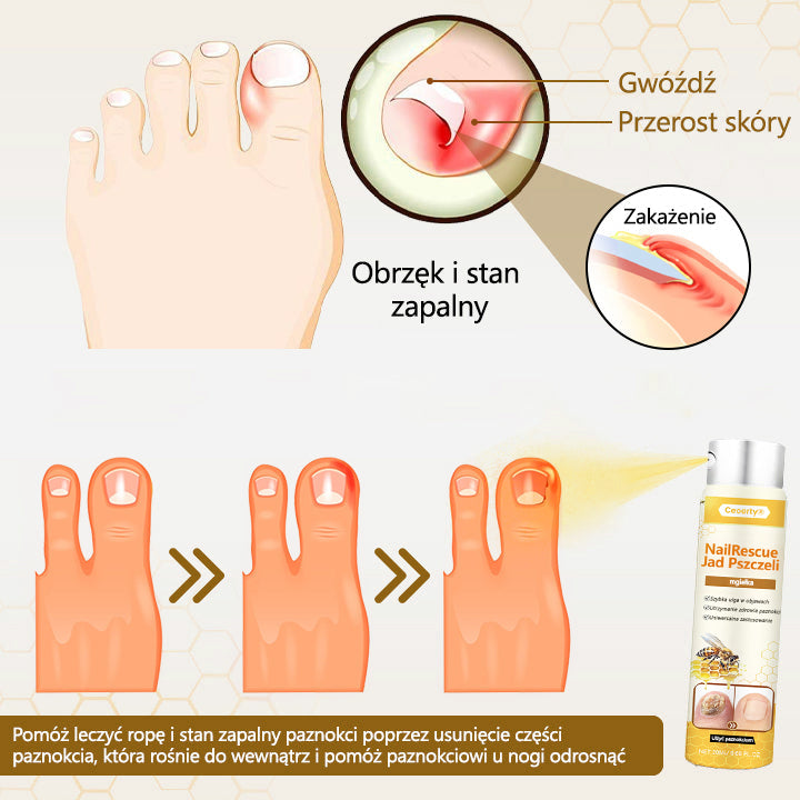 ✅【Oficjalny sklep flagowy】Ceoerty® spray z jadem pszczelim nailrescue