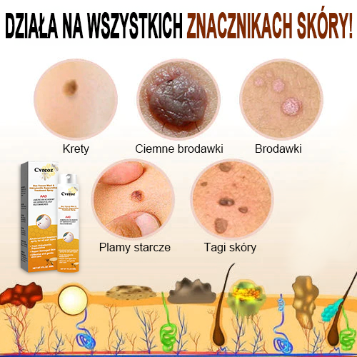🧡Cvreoz Preparat do usuwania brodawek i znamion z jadem pszczelim Spray (👨⚕AAD POLECA)🐝🐝 (🔥Ostatni dzień promocji 80% taniej)