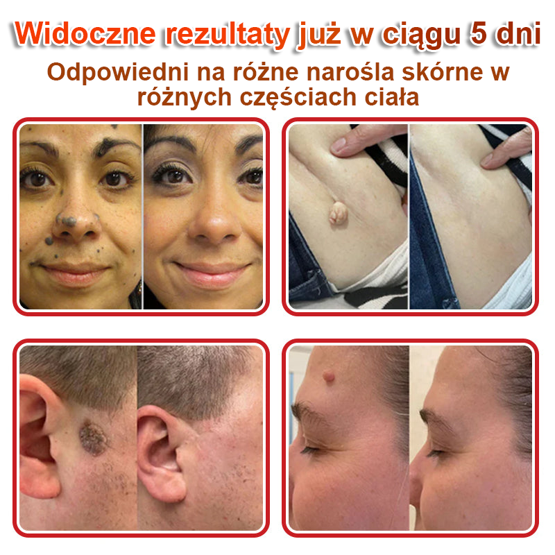 KUBOZN® Mikroigłowy botaniczny środek do usuwania narośli skórnych ✅✅✅✅wyprodukowano w Polsce