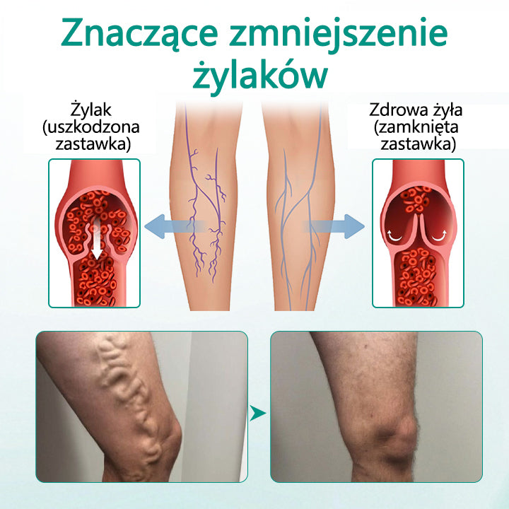 ✅✅✅✅Timilk® LegRenew Plaster na żylaki