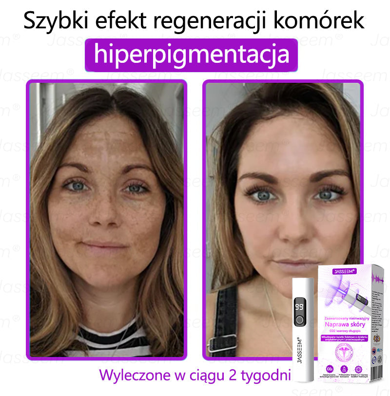 🔥🔥🔥𝐉𝐚𝐬𝐬𝐞𝐞𝐦® Zaawansowany nieinwazyjny laser CO₂ do naprawy skóry 🎉 (Delikatnie usuwa brodawki, znamiona, plamy starcze i narośla skórne – bez bólu, bez zamieszania!)