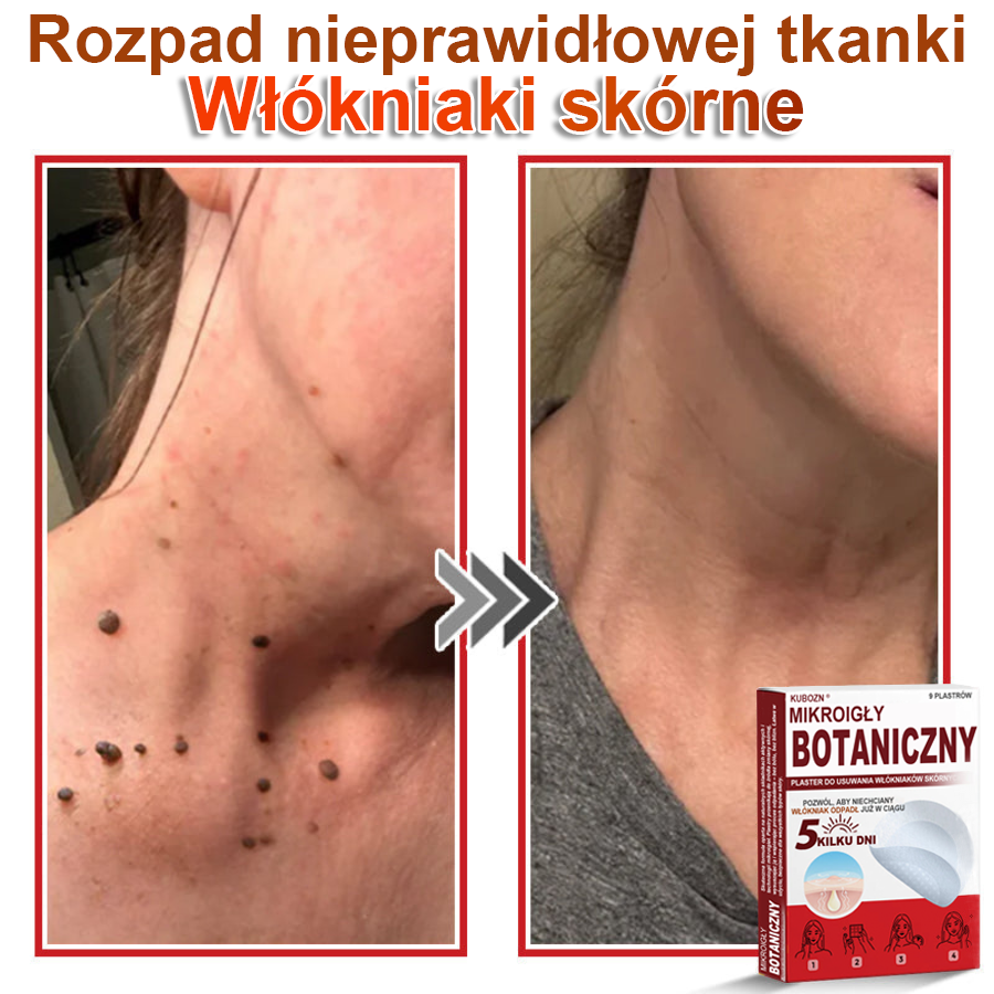 KUBOZN® Mikroigłowy botaniczny środek do usuwania narośli skórnych ✅✅✅✅wyprodukowano w Polsce