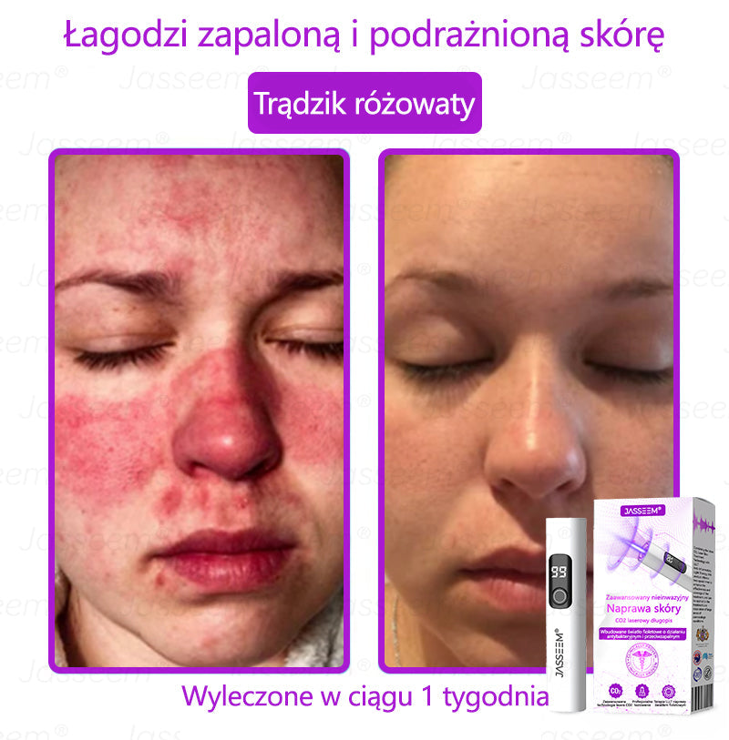 🔥🔥🔥𝐉𝐚𝐬𝐬𝐞𝐞𝐦® Zaawansowany nieinwazyjny laser CO₂ do naprawy skóry 🎉 (Delikatnie usuwa brodawki, znamiona, plamy starcze i narośla skórne – bez bólu, bez zamieszania!)