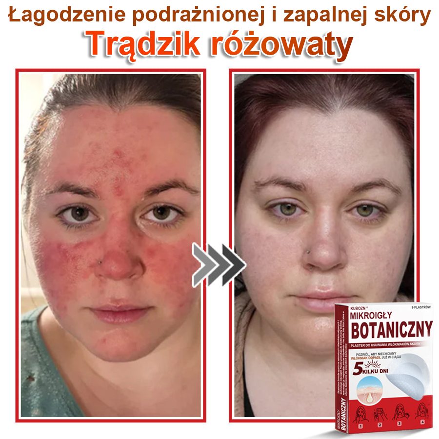 KUBOZN® Mikroigłowy botaniczny środek do usuwania narośli skórnych ✅✅✅✅wyprodukowano w Polsce