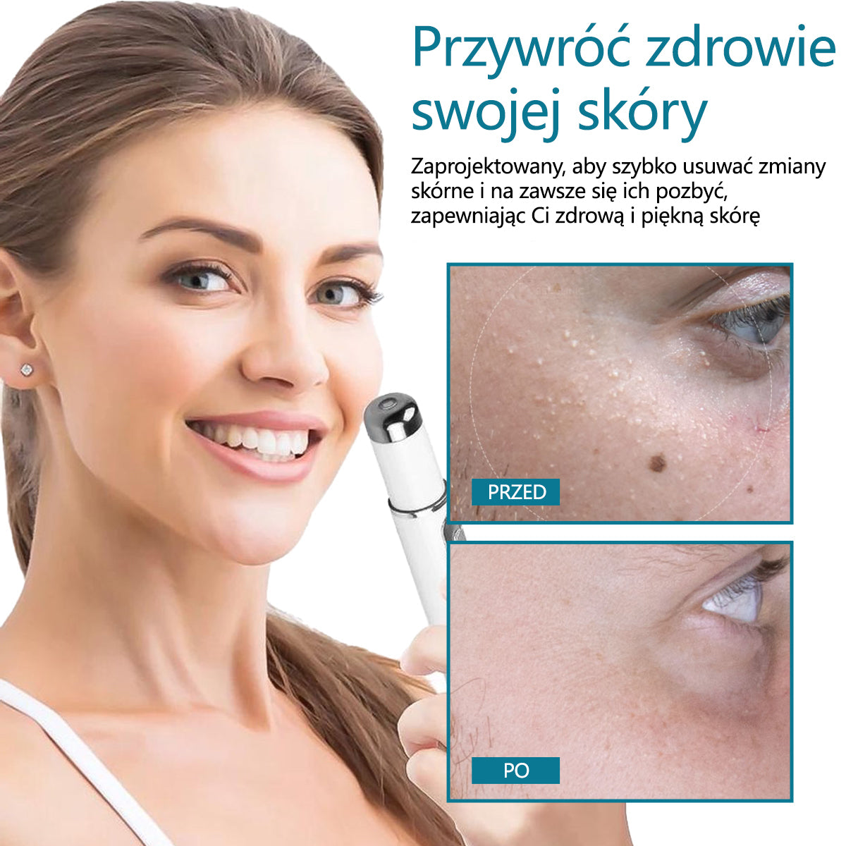 ✅Pióro laserowe do usuwania moli i brodawek Bikenda® LumeSkin