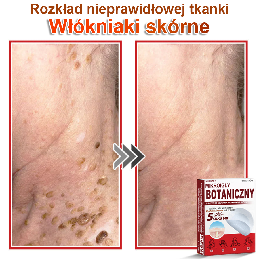 KUBOZN® Mikroigłowy botaniczny środek do usuwania narośli skórnych ✅✅✅✅wyprodukowano w Polsce