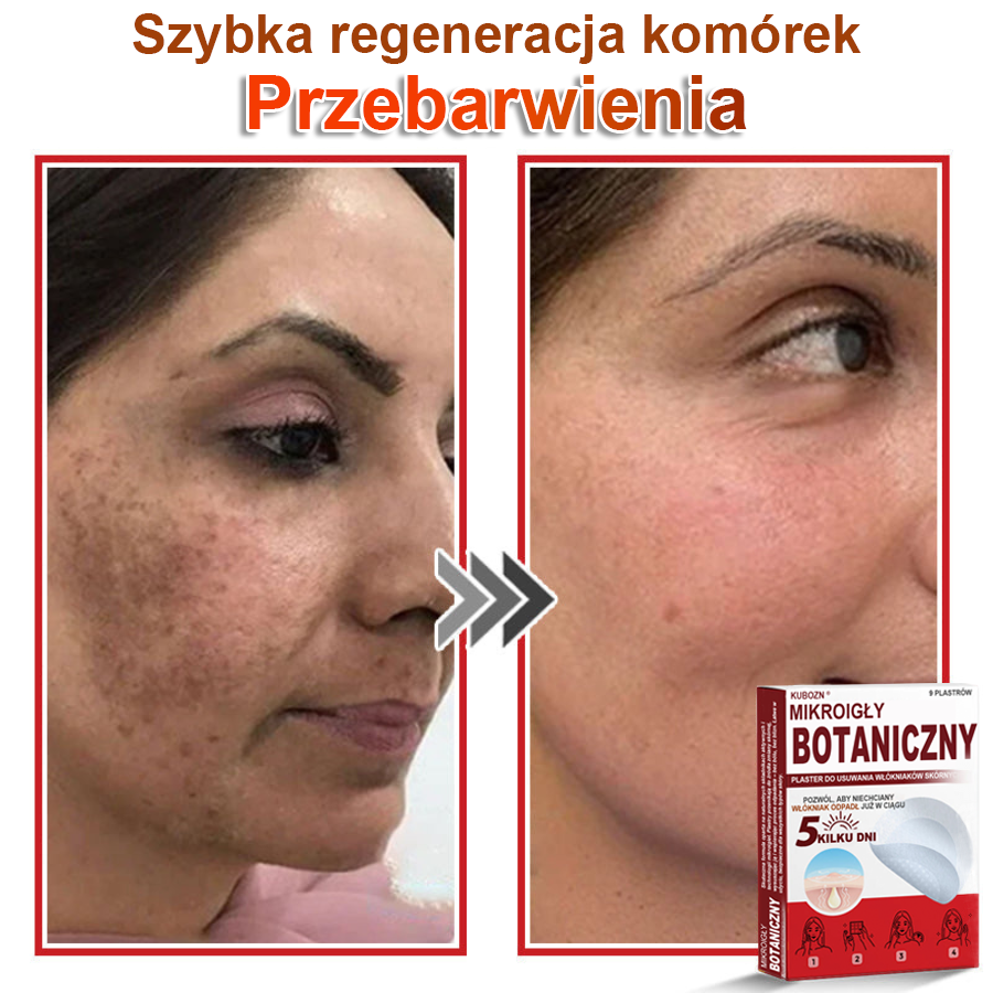 KUBOZN® Mikroigłowy botaniczny środek do usuwania narośli skórnych ✅✅✅✅wyprodukowano w Polsce