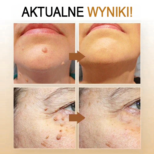 🧡Cvreoz Preparat do usuwania brodawek i znamion z jadem pszczelim Spray (👨⚕AAD POLECA)🐝🐝 (🔥Ostatni dzień promocji 80% taniej)