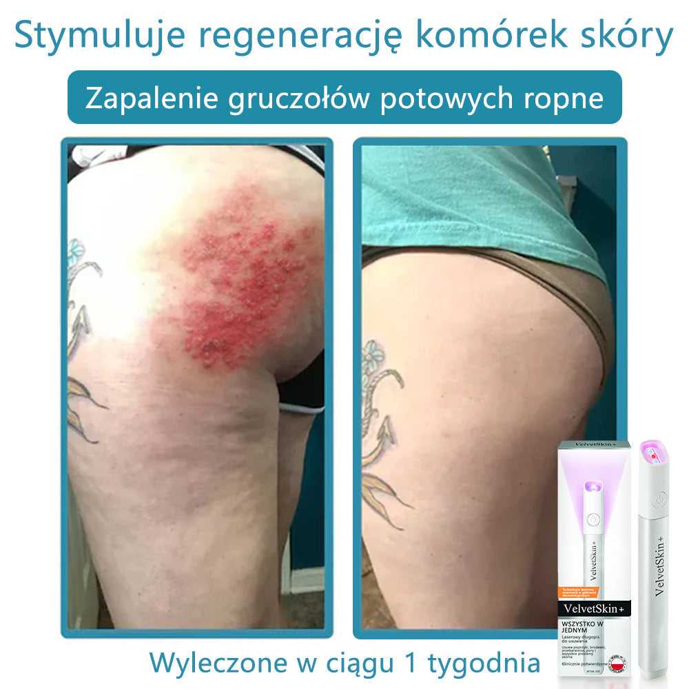 ✨✨✨ Bikenda® VelvetSkin+ – Laserowy Długopis CO₂ do Usuwania 🟤 Znamion, 🦠 Brodawek, 🔘 Przebarwień i Innych Niedoskonałości Skóry 🌿
