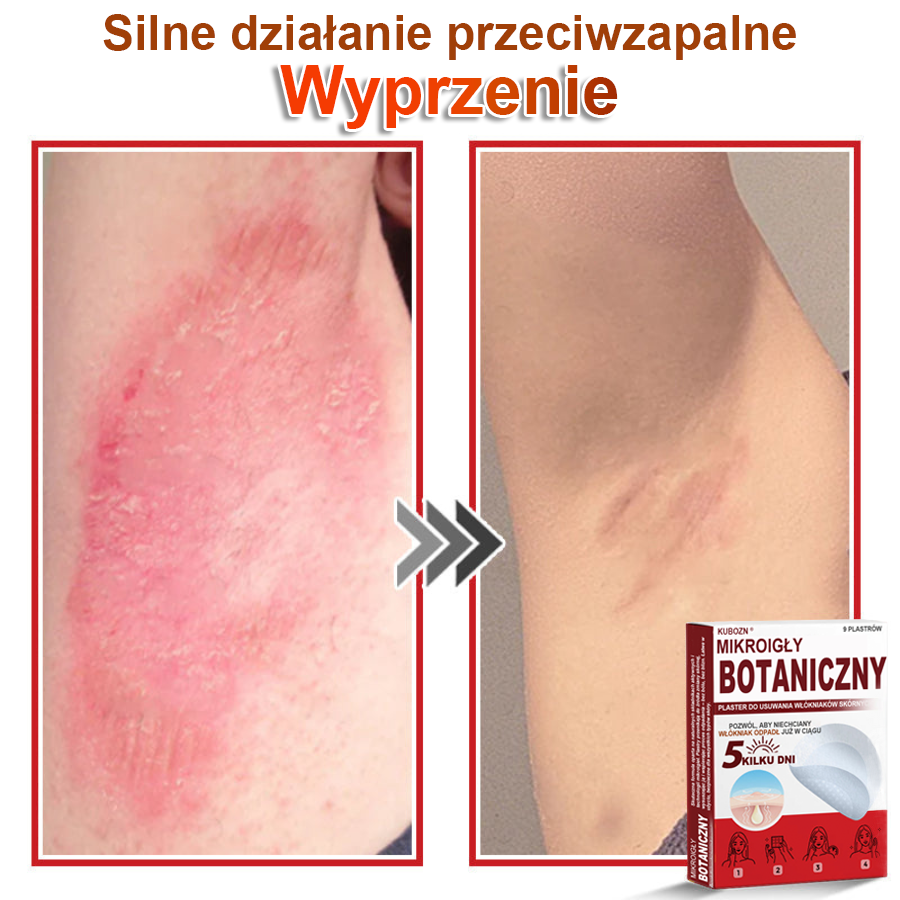 KUBOZN® Mikroigłowy botaniczny środek do usuwania narośli skórnych ✅✅✅✅wyprodukowano w Polsce