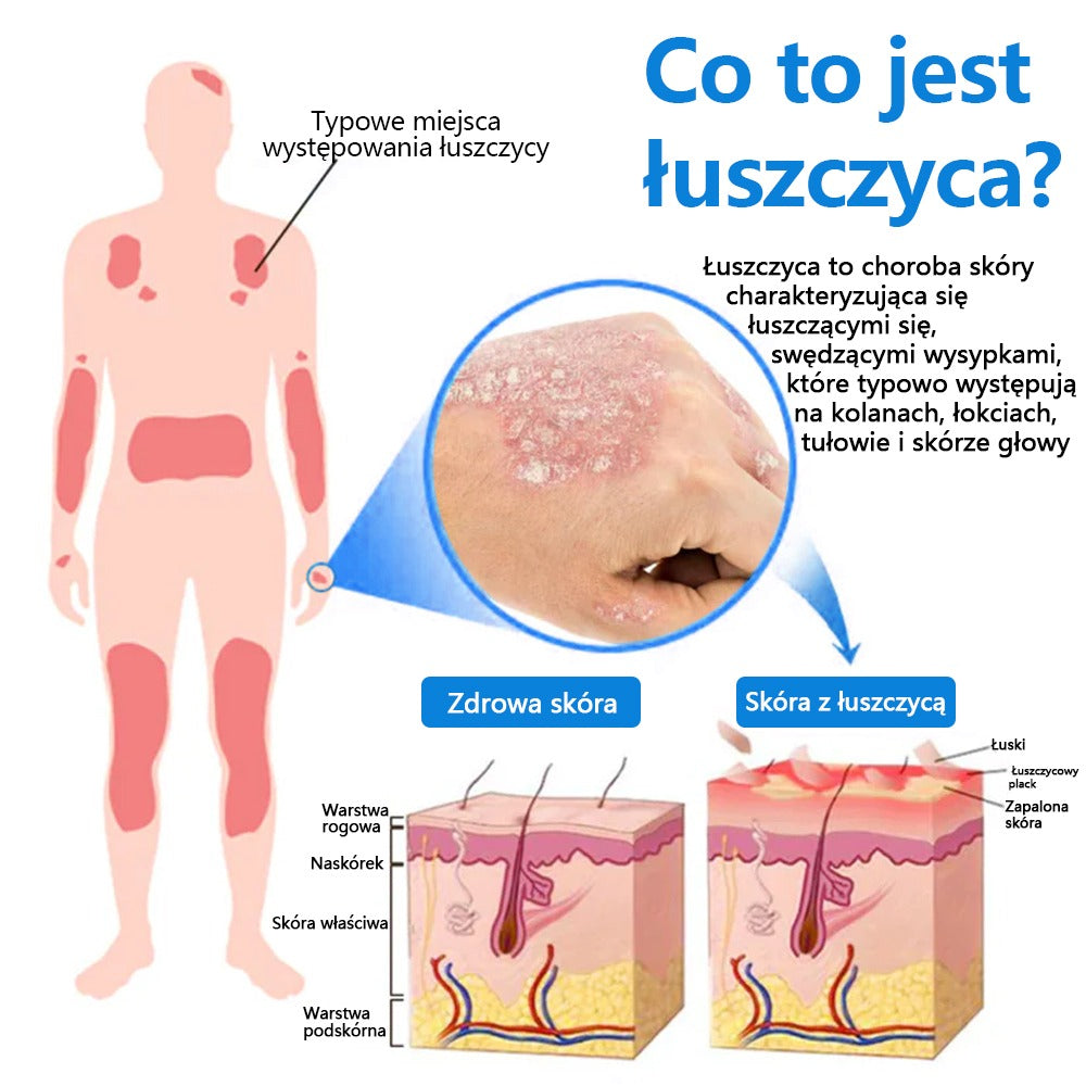 Oficjalny sklep✅: Zvoevo®Magnezowy spray ziołowy na łuszczycę⚕️Certyfikowany przez URPL (ulga w łuszczycy i egzemie, poprawa stanu bakteryjnych infekcji narządów płciowych oraz leczenie trądziku i przebarwień)✨✨✨✨