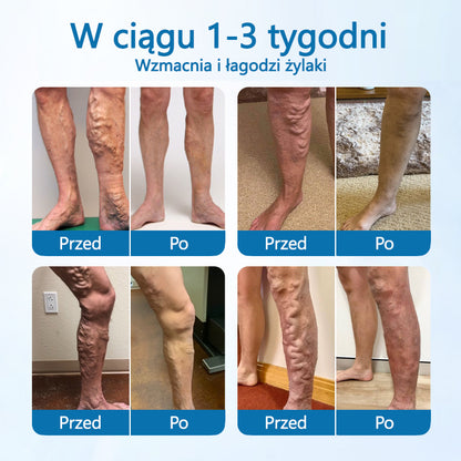 Timilk® VeinGuard Herbal Spray-✅✅✅ Klinicznie udowodniono, że eliminuje żylaki w zaledwie 7 dni!