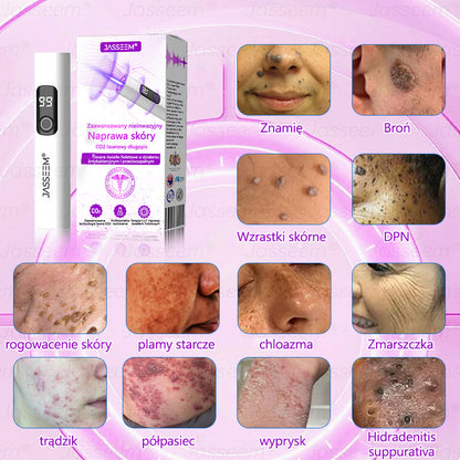 🔥🔥🔥𝐉𝐚𝐬𝐬𝐞𝐞𝐦® Zaawansowany nieinwazyjny laser CO₂ do naprawy skóry 🎉 (Delikatnie usuwa brodawki, znamiona, plamy starcze i narośla skórne – bez bólu, bez zamieszania!)