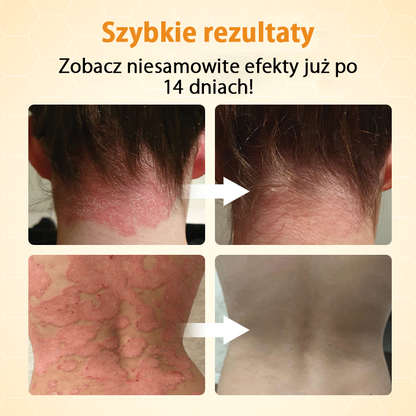 Timilk® BeeLieve Łuszczyca Pielęgnacja skóry🌿🌿🌿