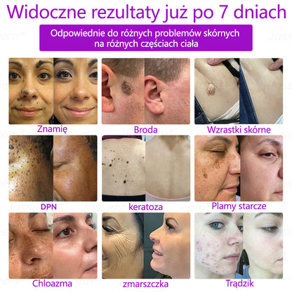 🔥🔥🔥𝐉𝐚𝐬𝐬𝐞𝐞𝐦® Zaawansowany nieinwazyjny laser CO₂ do naprawy skóry 🎉 (Delikatnie usuwa brodawki, znamiona, plamy starcze i narośla skórne – bez bólu, bez zamieszania!)
