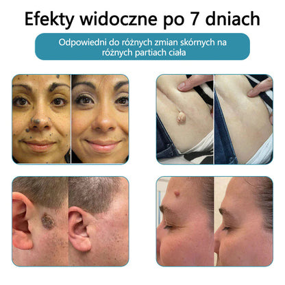 ✨✨✨ Bikenda® VelvetSkin+ – Laserowy Długopis CO₂ do Usuwania 🟤 Znamion, 🦠 Brodawek, 🔘 Przebarwień i Innych Niedoskonałości Skóry  🌿