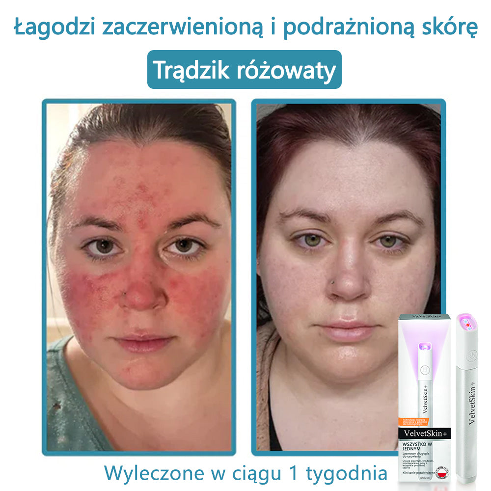 ✨✨✨ Bikenda® VelvetSkin+ – Laserowy Długopis CO₂ do Usuwania 🟤 Znamion, 🦠 Brodawek, 🔘 Przebarwień i Innych Niedoskonałości Skóry  🌿