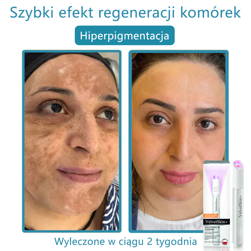 ✨✨✨ Bikenda® VelvetSkin+ – Laserowy Długopis CO₂ do Usuwania 🟤 Znamion, 🦠 Brodawek, 🔘 Przebarwień i Innych Niedoskonałości Skóry  🌿