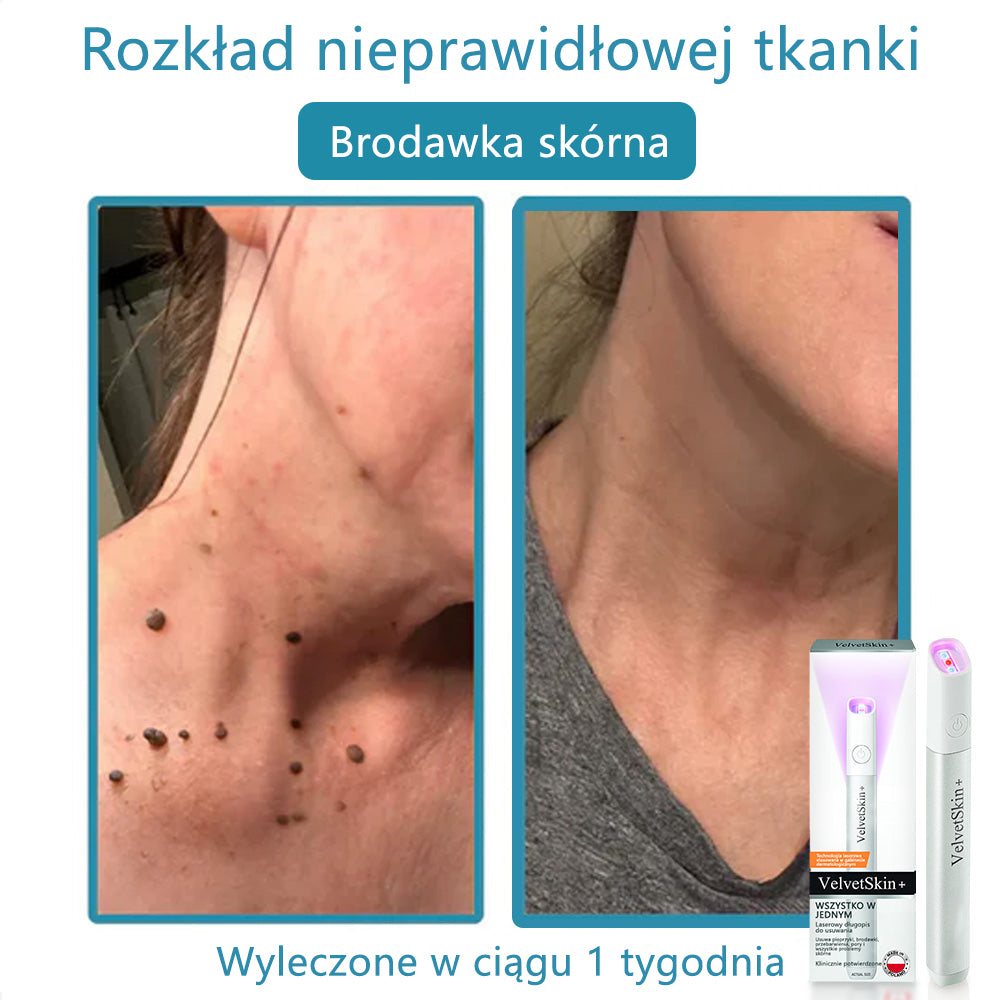 ✨✨✨ Bikenda® VelvetSkin+ – Laserowy Długopis CO₂ do Usuwania 🟤 Znamion, 🦠 Brodawek, 🔘 Przebarwień i Innych Niedoskonałości Skóry  🌿