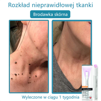 ✨✨✨ Bikenda® VelvetSkin+ – Laserowy Długopis CO₂ do Usuwania 🟤 Znamion, 🦠 Brodawek, 🔘 Przebarwień i Innych Niedoskonałości Skóry  🌿