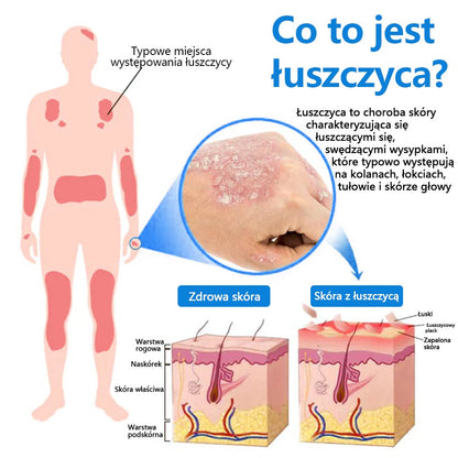 Oficjalny sklep✅: Zvoevo®Magnezowy spray ziołowy na łuszczycę⚕️Certyfikowany przez URPL (ulga w łuszczycy i egzemie, poprawa stanu bakteryjnych infekcji narządów płciowych oraz leczenie trądziku i przebarwień)✨✨