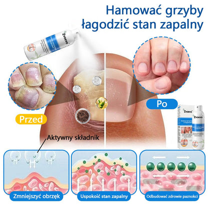 Oficjalny sklep✅: Zvoevo®Magnezowy spray ziołowy na łuszczycę⚕️Certyfikowany przez URPL (ulga w łuszczycy i egzemie, poprawa stanu bakteryjnych infekcji narządów płciowych oraz leczenie trądziku i przebarwień)✨✨
